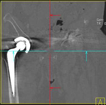 Right Total Hip Replacement - CTisus CT Scan