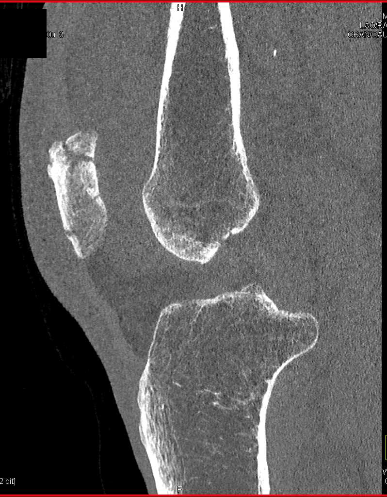 Patella Fracture - CTisus CT Scan