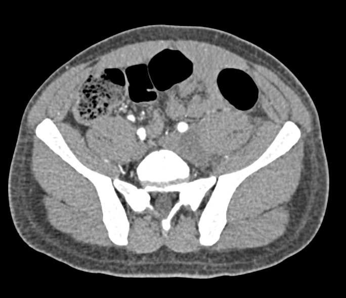 Lymphoma Infiltrates through Muscle - CTisus CT Scan