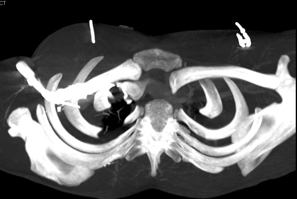 Posterior Dislocation of the Left Clavicle at Sternoclavicular Joint (SC Joint) - CTisus CT Scan