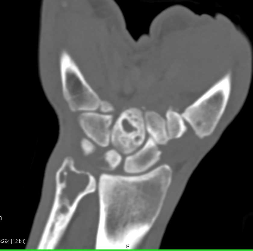 Multiple Cysts in the Carpal Bones due to Trauma - CTisus CT Scan