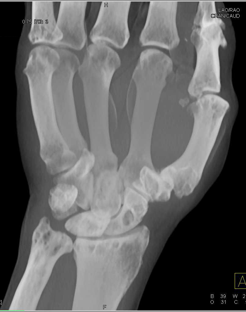 Multiple Cysts In The Carpal Bones Due To Trauma Musculoskeletal Case