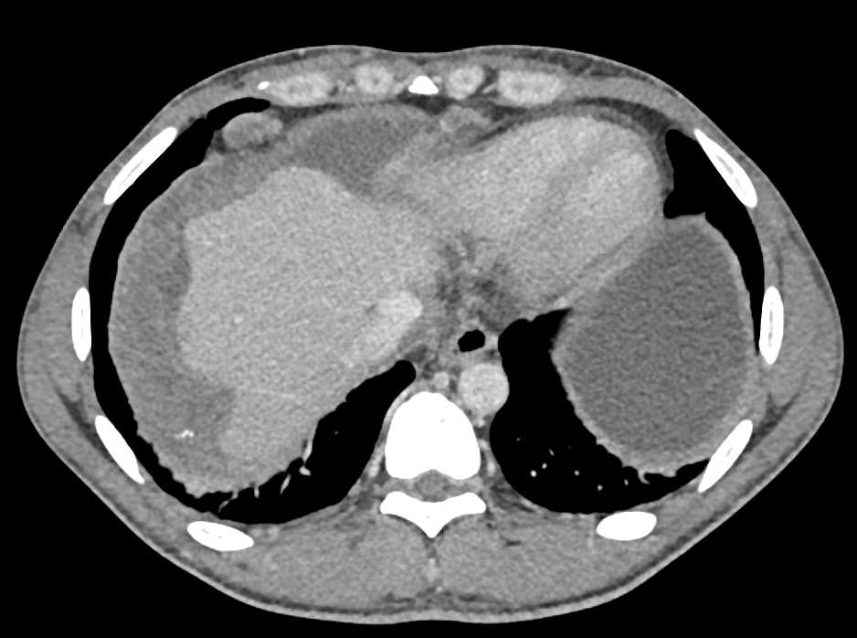 Bleed Right Thigh in Patient with Carcinomatosis - CTisus CT Scan