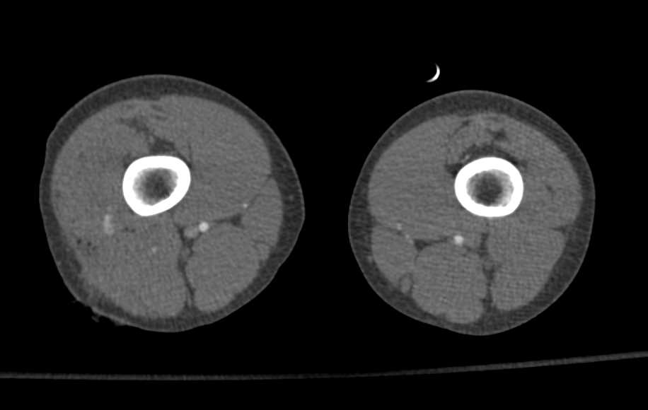 Stab Right Thigh with Active Bleed and Pseudoaneurysm - CTisus CT Scan