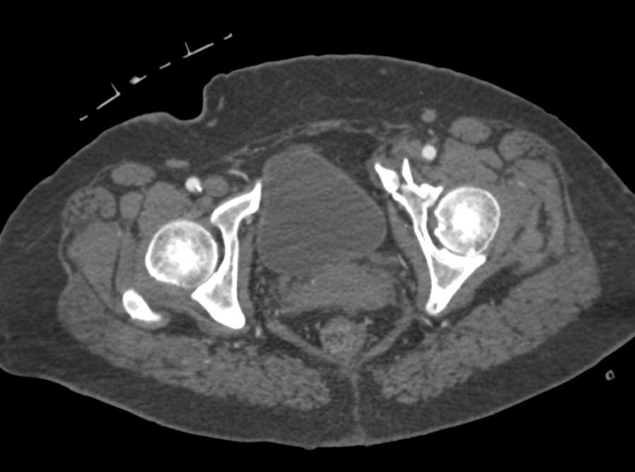 Left Anterior Column Fracture and Fracture of Tibia and Fibula - CTisus CT Scan