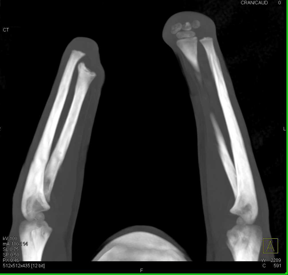 Patient with Hand Tranplant Candidate - CTisus CT Scan