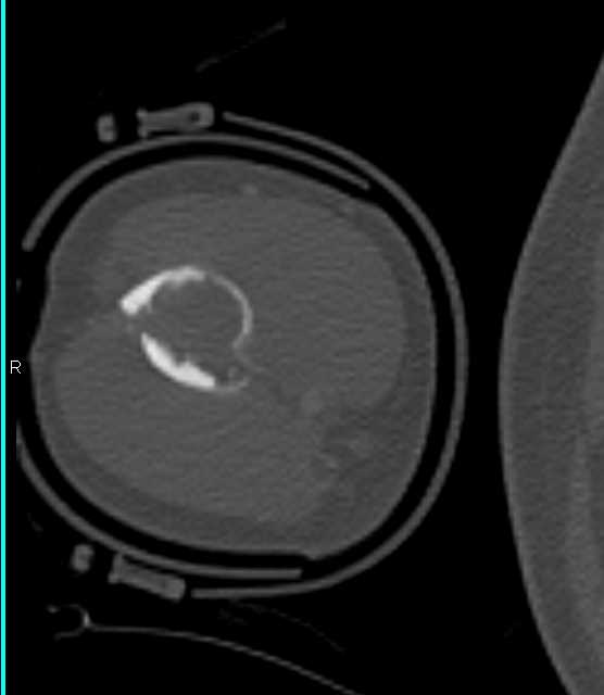 Fracture Through a Bone Cyst - CTisus CT Scan