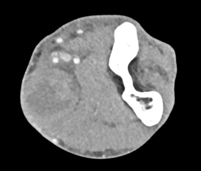 Abscess in Antecubital Fossa in a Drug Addict - CTisus CT Scan