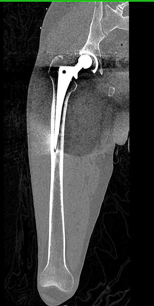 3D Mapping of a Total Hip Replacement - CTisus CT Scan