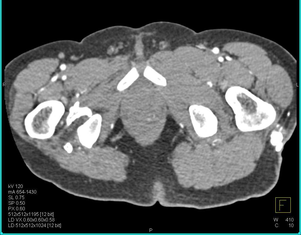 Heterotopic Ossification Right Hip - CTisus CT Scan