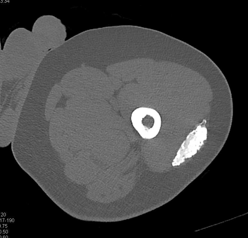 Heterotopic Ossification Right Hip - CTisus CT Scan