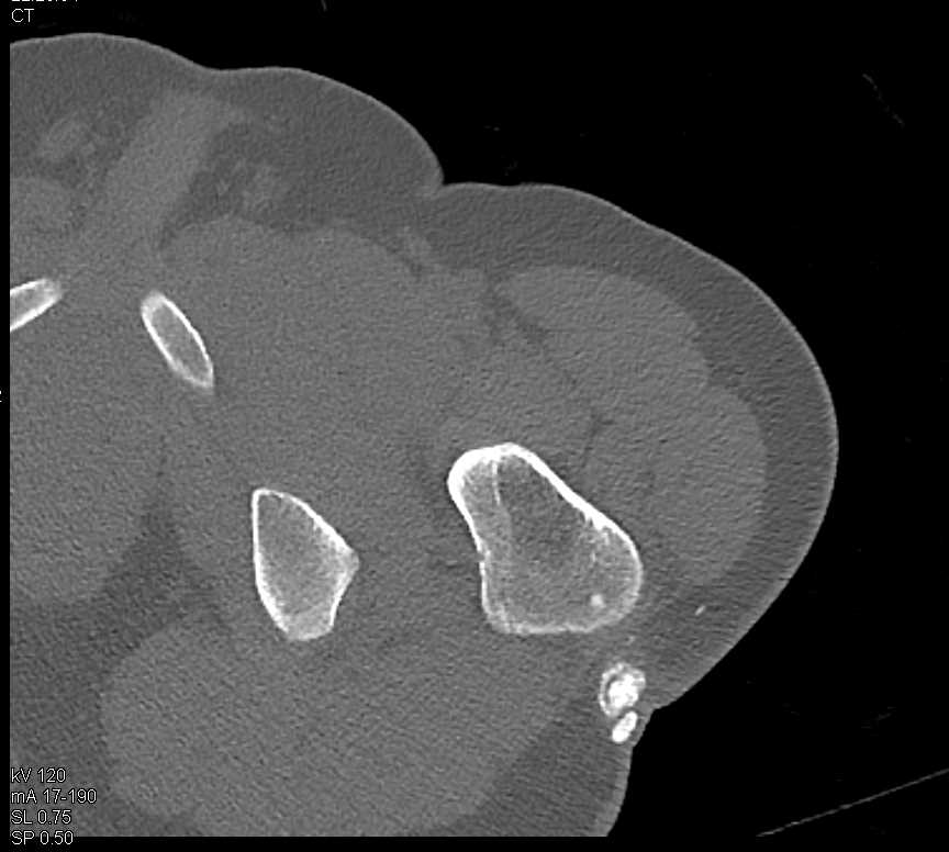 Heterotopic Ossification Left Hip and Knee - CTisus CT Scan