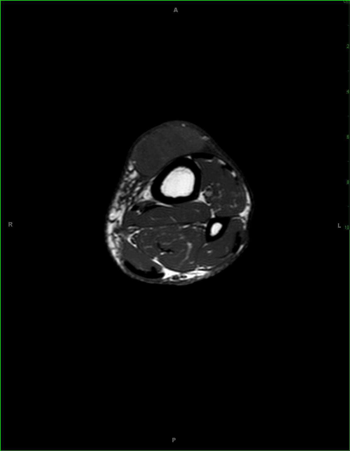 Spindle Cell Sarcoma, Leg - CTisus CT Scan