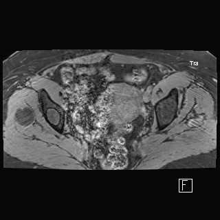 Mazabraud Syndrome - CTisus CT Scan