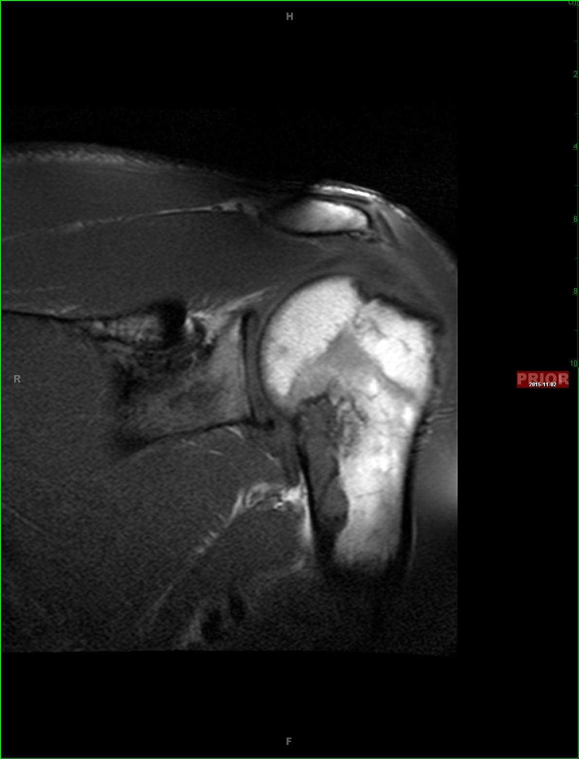 Polyostotic Fibrous Dysplasia - CTisus CT Scan