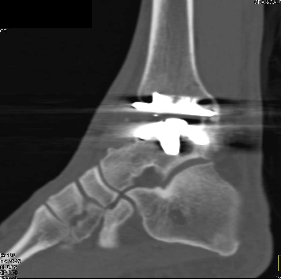 Ankle Joint Hardware - CTisus CT Scan