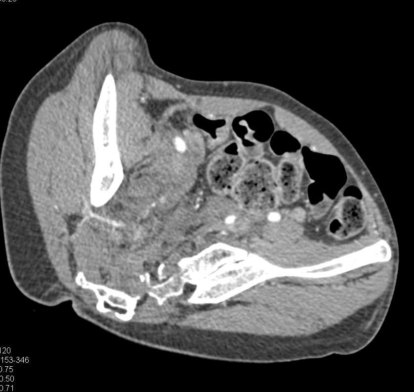 Complex Sacral Fracture with Hematoma and Pelvic Ring Fractures Involving the Symphysis - CTisus CT Scan