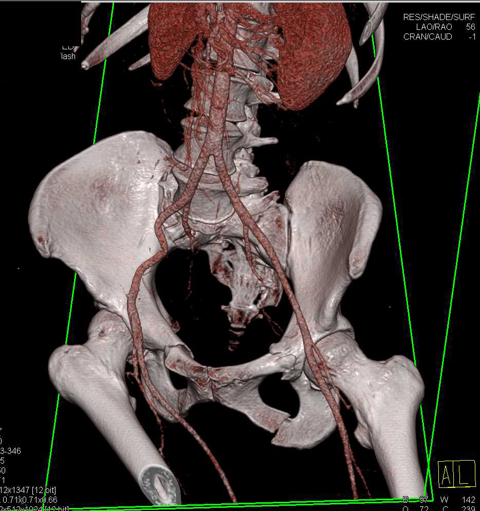 Complex Sacral Fracture with Hematoma and Pelvic Ring Fractures ...