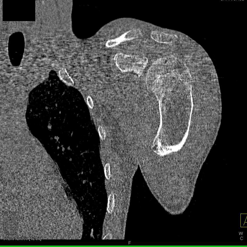 Multiple Exostosis Scapula and Humerus - CTisus CT Scan