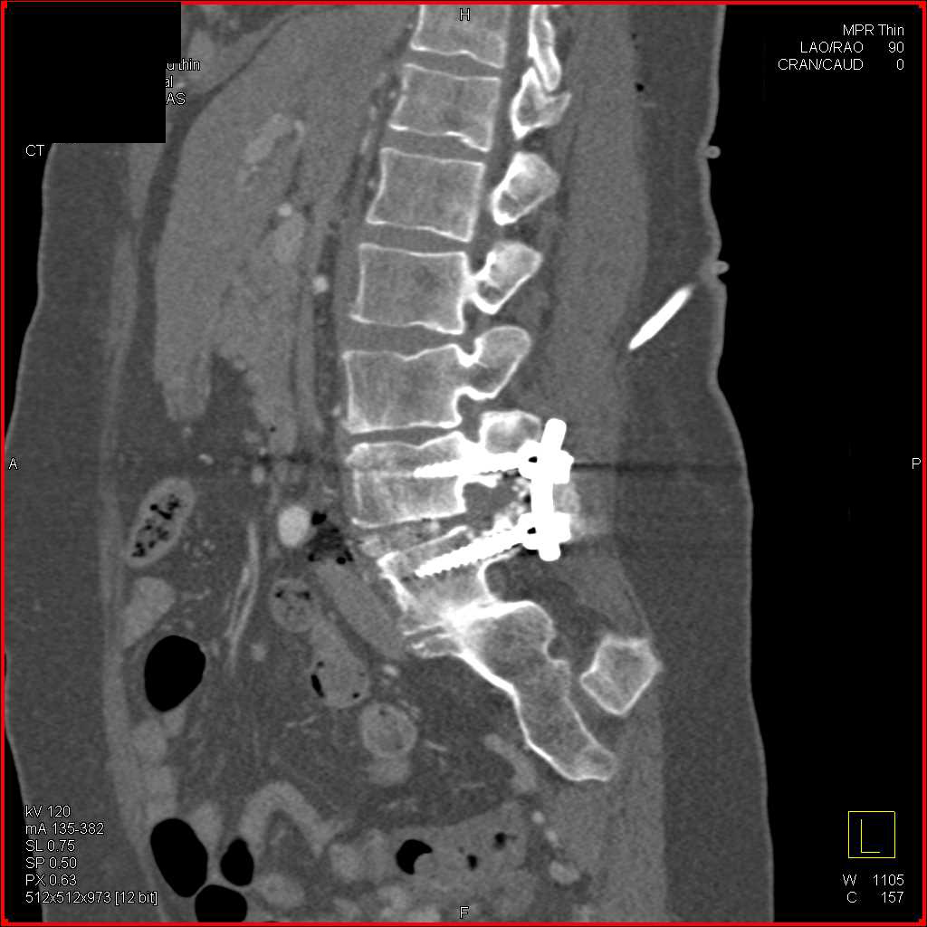 Hardware Repair L-Spine with Hardware Position Poor - CTisus CT Scan