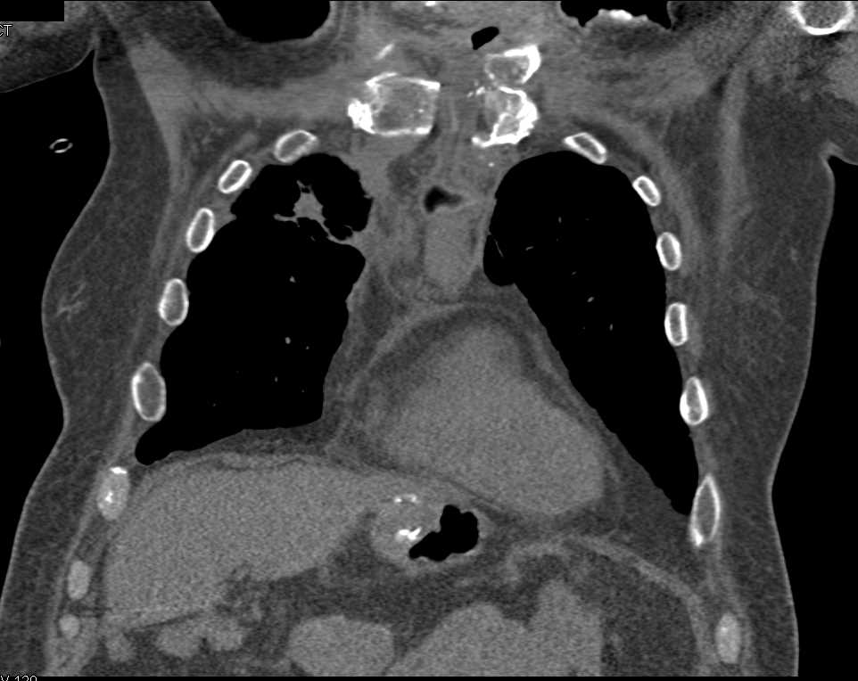 Osteomyelitis Sternum with Abscess - CTisus CT Scan