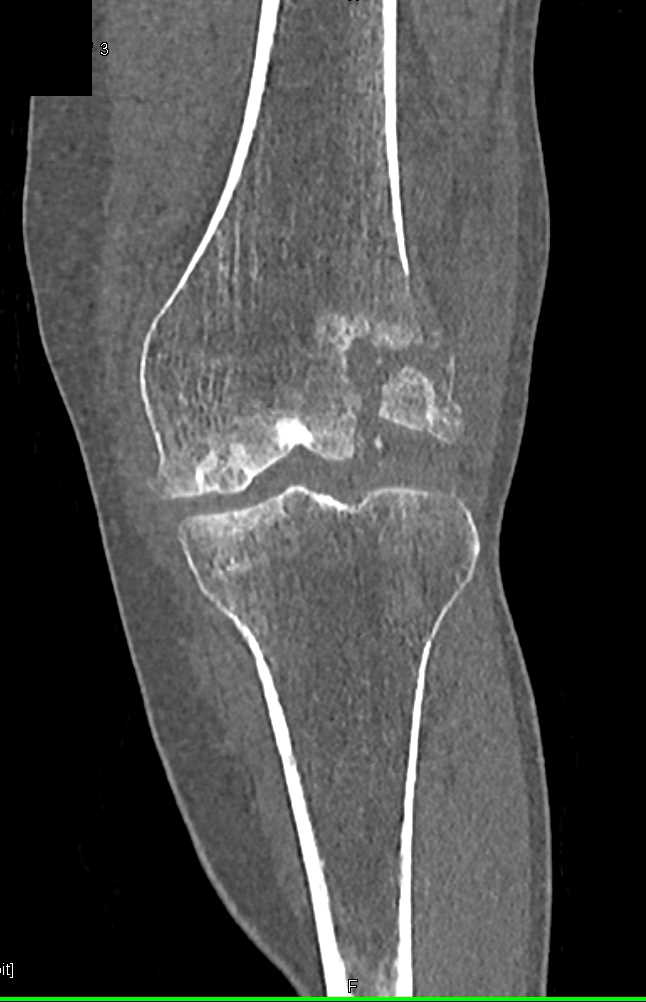 Renal Cell Carcinoma Metastatic to Femur - CTisus CT Scan