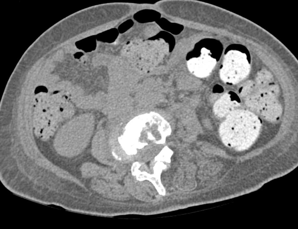 Osteomyelitis L-Spine as well as Acute Pyelonephritis - CTisus CT Scan