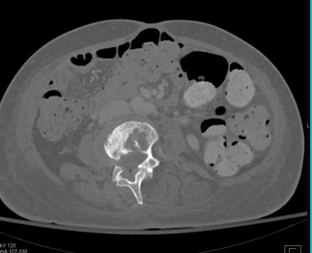 Osteomyelitis L-Spine as well as Acute Pyelonephritis - CTisus CT Scan