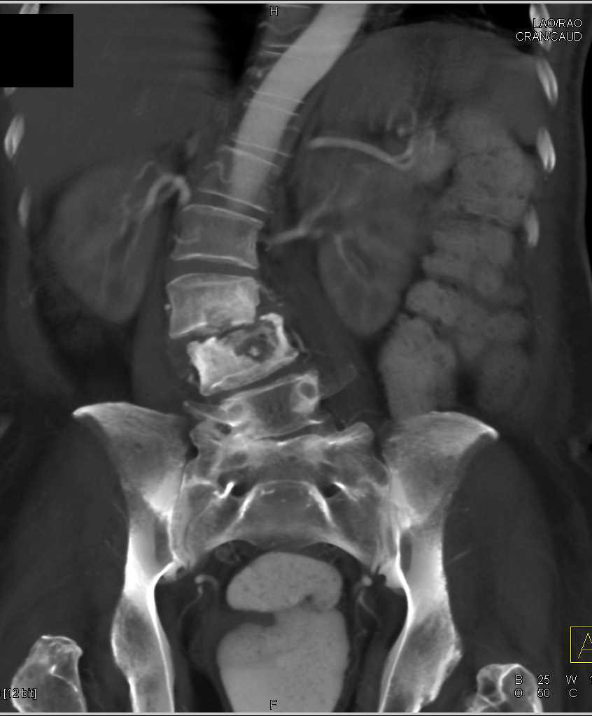 Osteomyelitis L-Spine - CTisus CT Scan