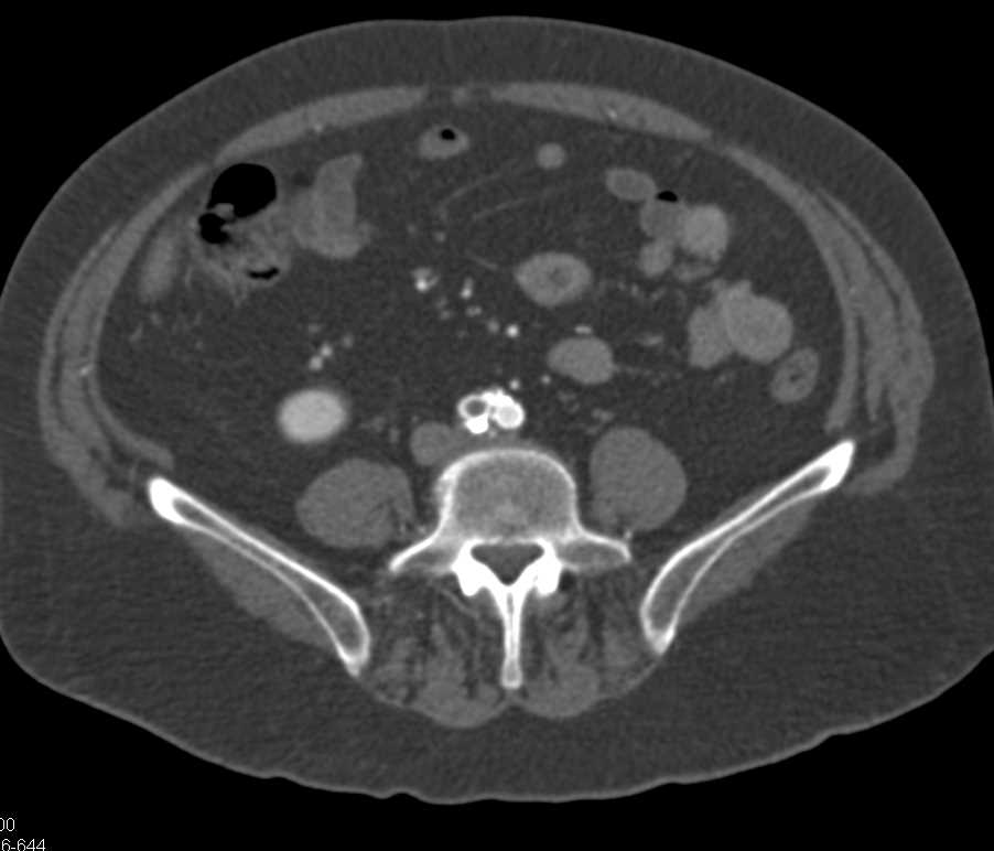 Automatic Bone Removal with Dual Energy Makes an Error and Assumes the Right Common Iliac Artery is Occluded - CTisus CT Scan