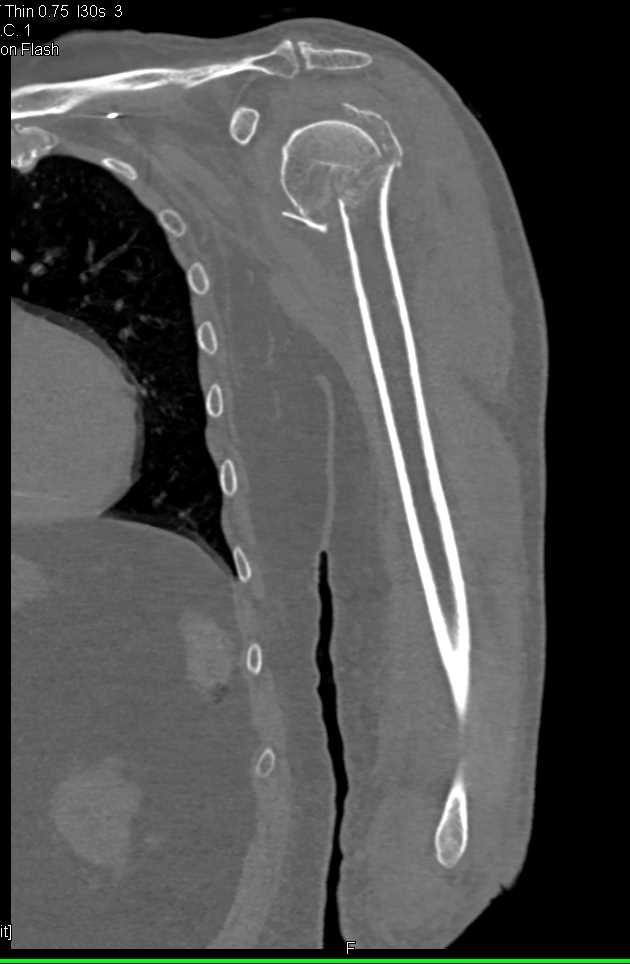 Fracture of Humerus and Glenoid - CTisus CT Scan