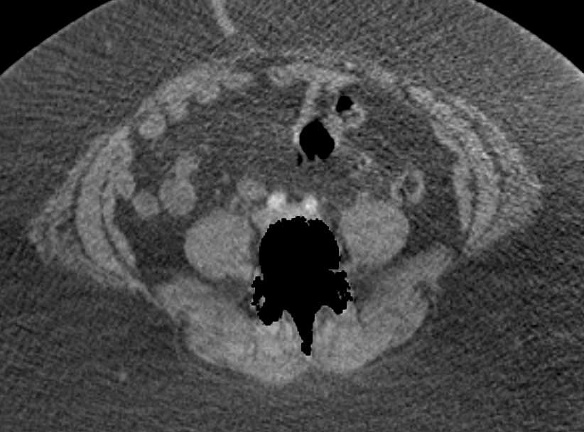 Dual Energy with Automatic Bone Removal - CTisus CT Scan