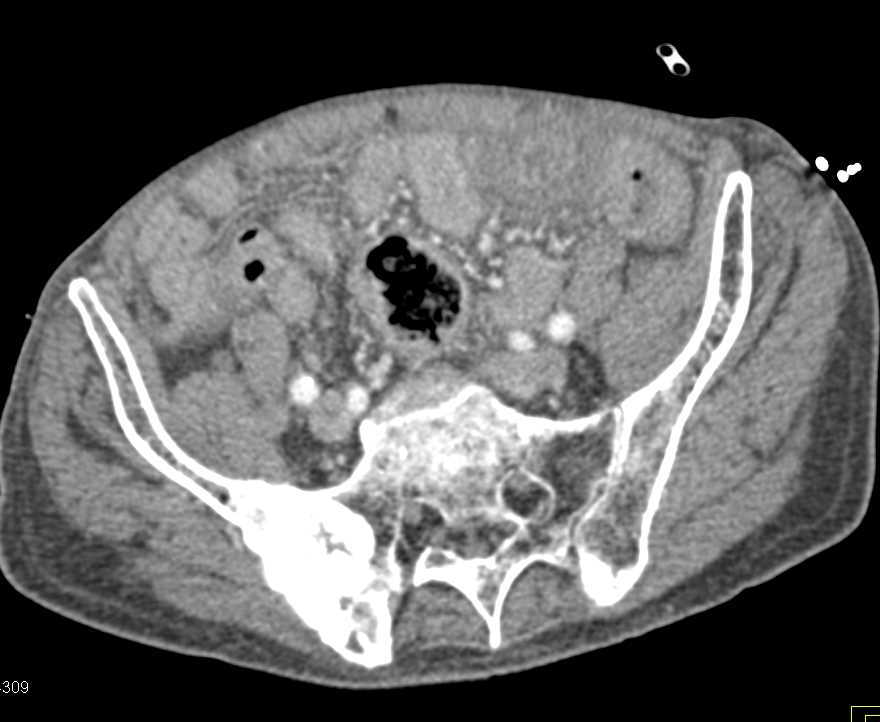 Widespread Blastic Bone Metastases from Prostate Cancer - CTisus CT Scan