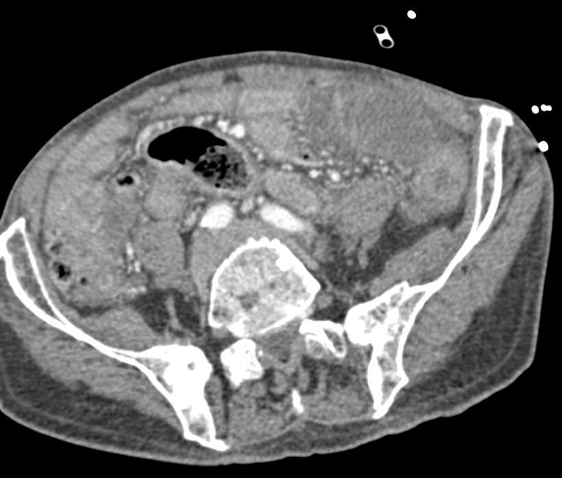 Widespread Blastic Bone Metastases from Prostate Cancer - CTisus CT Scan