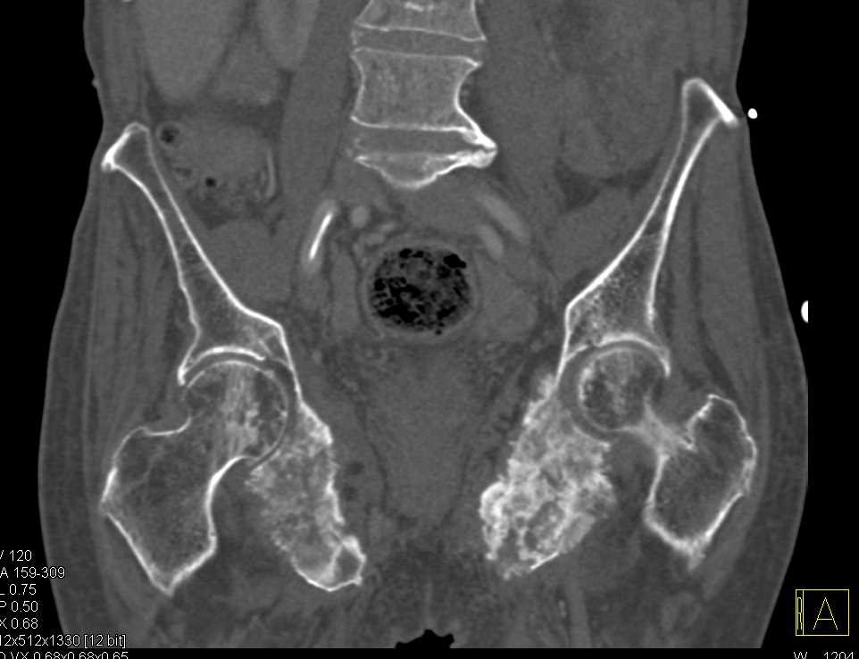 Widespread Blastic Bone Metastases From Prostate Cancer 9701