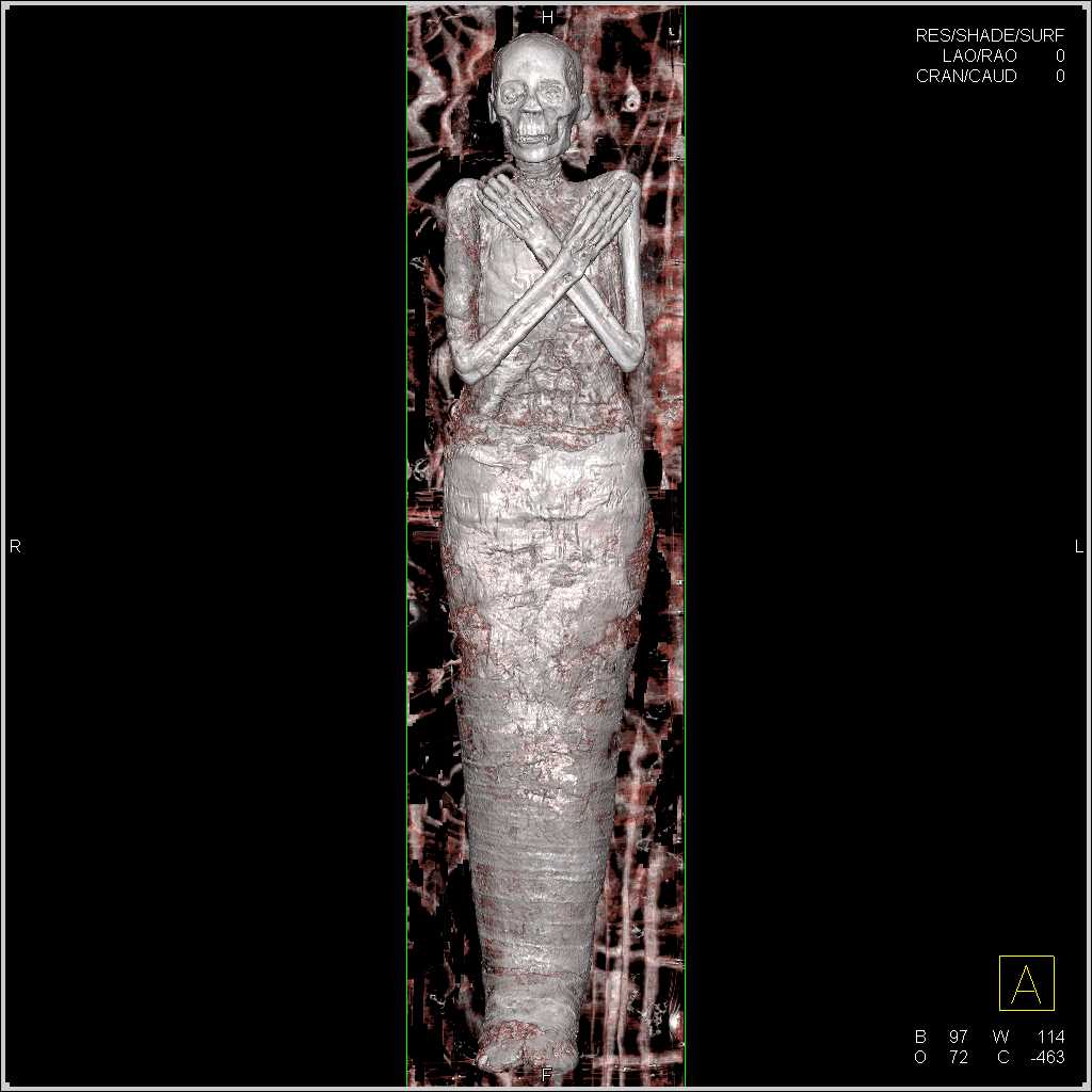 3D of a Mummy - CTisus CT Scan