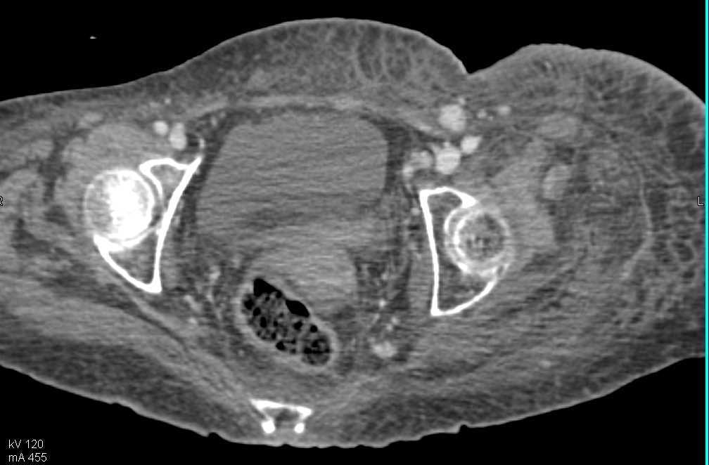 Multiple Tumor Nodules in the Thigh above the Level of Amputation - CTisus CT Scan