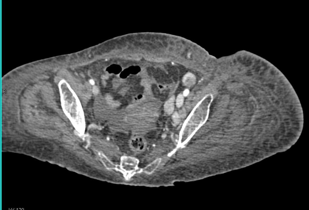 Multiple Tumor Nodules in the Thigh above the Level of Amputation - CTisus CT Scan