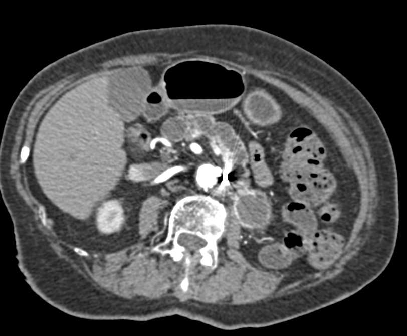 Vascular Muscle Metastases from Renal Cell Carcinoma - CTisus CT Scan