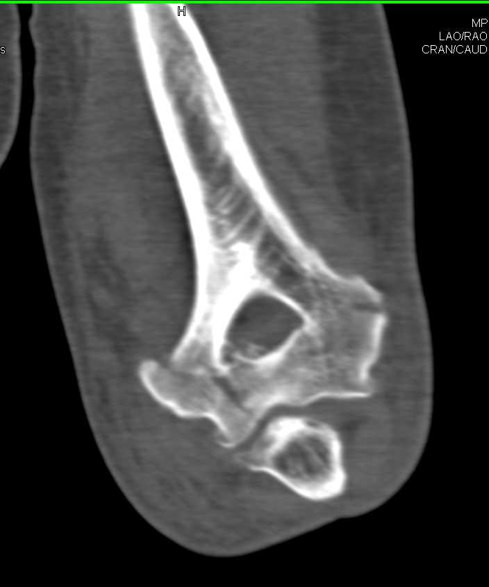 Comminuted Fracture of the Distal Humerus - CTisus CT Scan