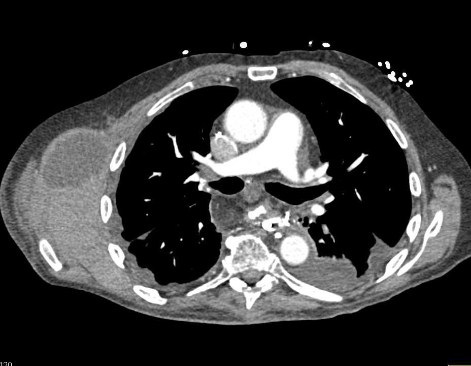 Axillary Bleed in Patient with Polycystic Liver Disease - CTisus CT Scan