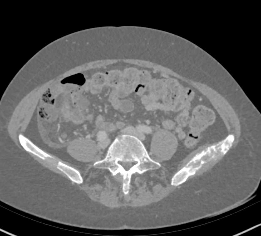 Metastatic Lung Cancer to Bone - CTisus CT Scan