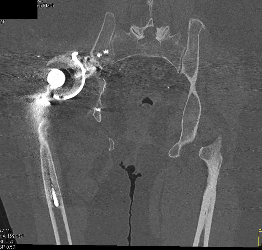 Failed Right Total Hip Replacement (THR) with Dislocated Hip - CTisus CT Scan