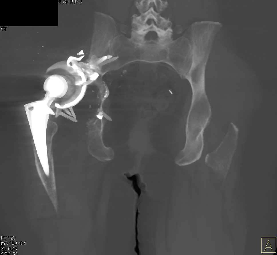 Failed Right Total Hip Replacement Thr With Dislocated Hip
