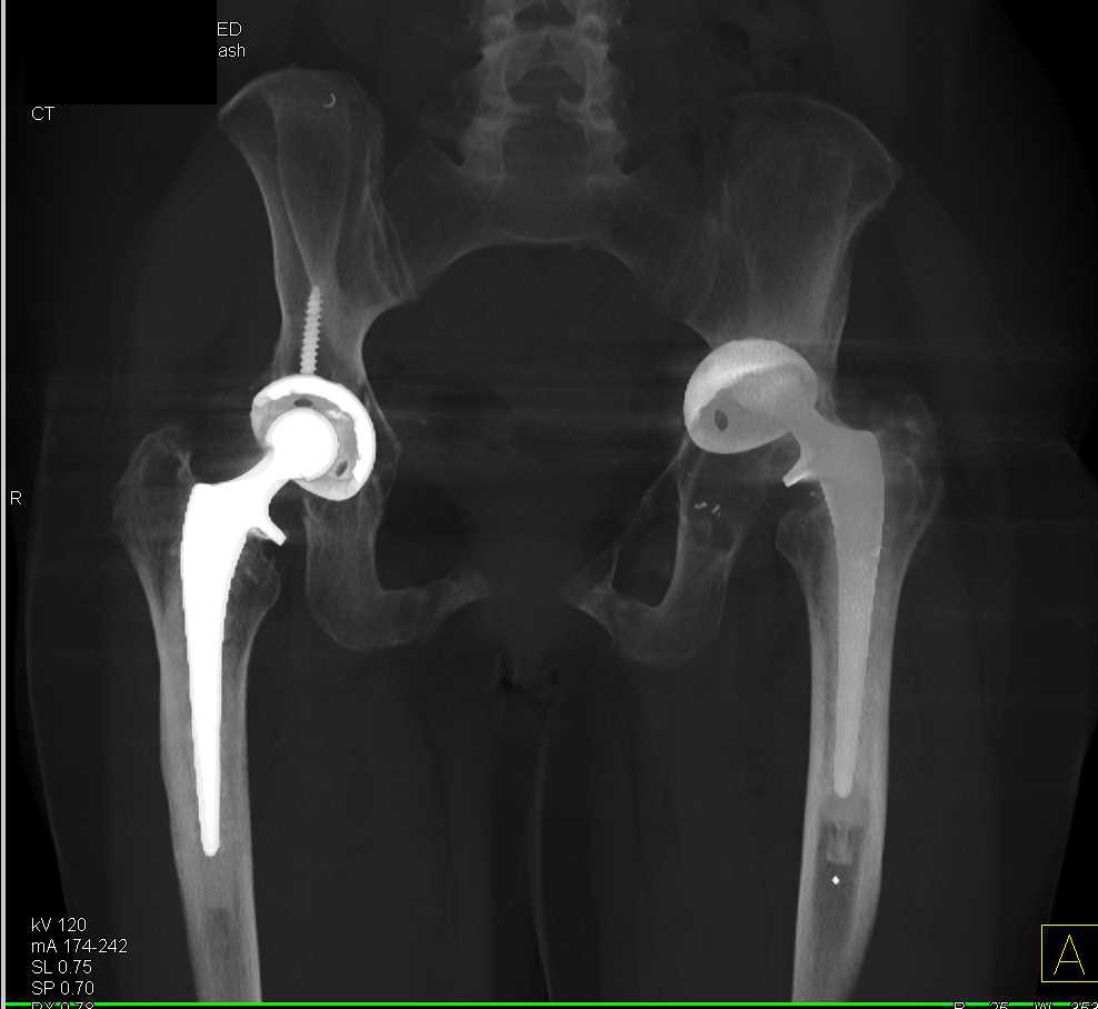 Failed Left Total Hip Replacement - CTisus CT Scan