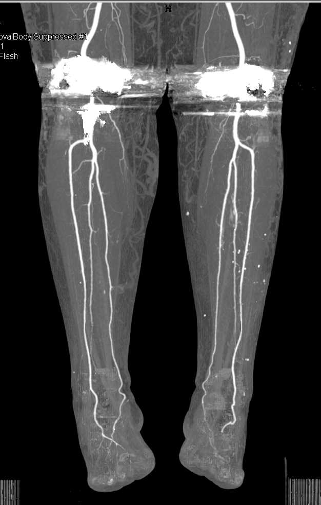 CTA Runoff in a Patient with Bilateral Total Knee Replacements - CTisus CT Scan