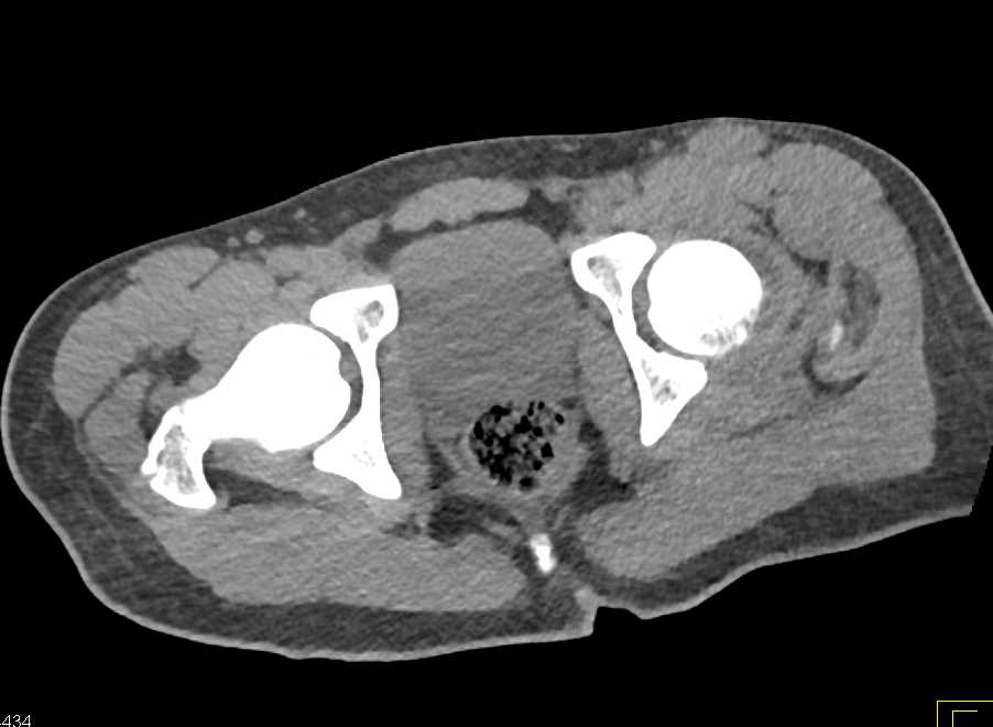 Intra-articular Fragment in the Left Hip Joint Following Left Hip Fracture and Dislocation - CTisus CT Scan