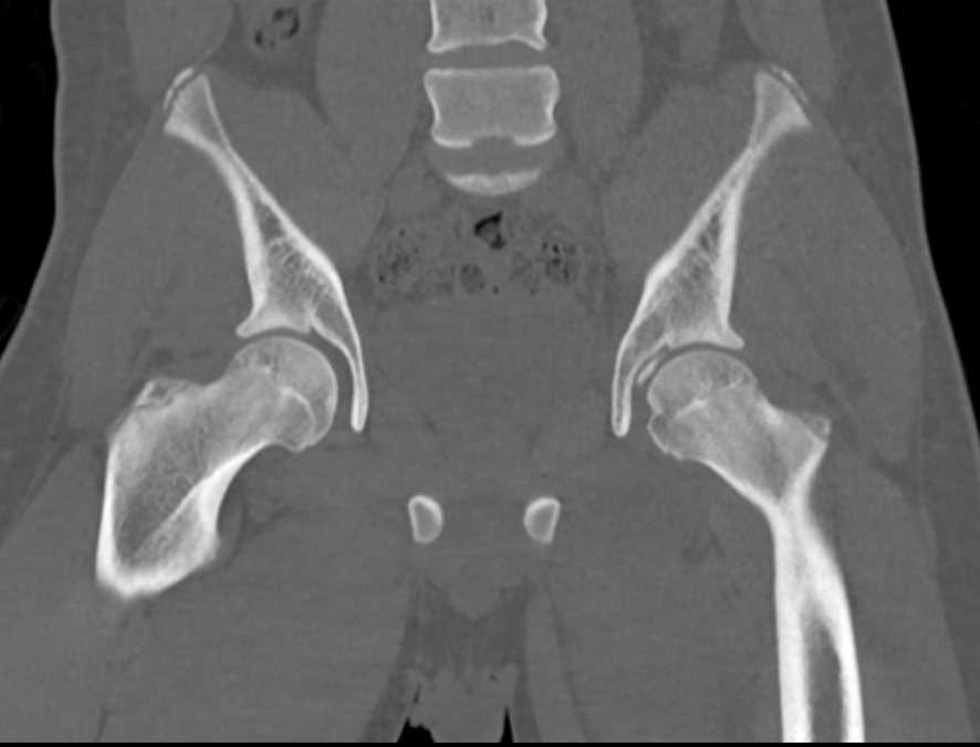 Hip Fracture Ct Scan