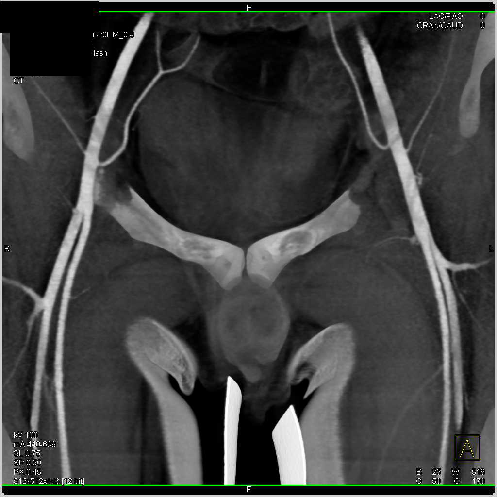 Mapping of Pelvic Vasculature for a Flap Procedure - CTisus CT Scan