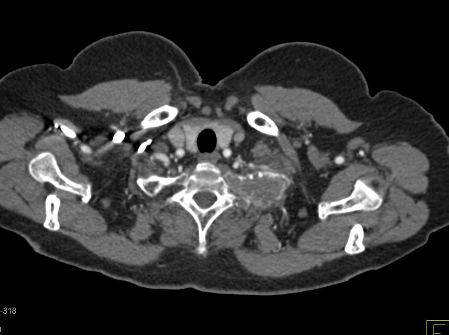 Expansile Rib in Metastatic Lung Cancer - CTisus CT Scan